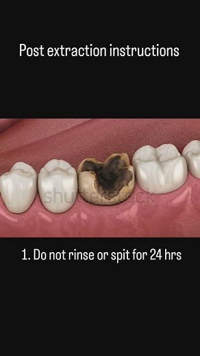 Dr Fahmina Jamil Rajput on Instagram: "Post-Operative Instructions for Tooth Extraction: Bleeding: Bite firmly on the gauze pad placed over the extraction site for 30-45 minutes to control bleeding. If bleeding continues, replace the gauze and bite down firmly for an additional 30 minutes. Avoid spitting, rinsing, or using straws for the first 24 hours to prevent dislodging the clot. Pain Management: Take prescribed pain medication as directed. Over-the-counter painkillers like ibuprofen can als