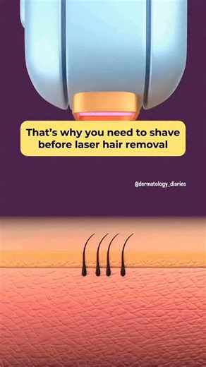 Dr Preeti Mor on Instagram: "Why do you need to shave before laser hair removal? Many people think you should let the hair grow a little before the procedure but with laser, it’s the opposite. Shaving 12–24 hours before your session helps the laser work as effectively and safely as possible. Here’s why: ✔️ The laser targets the hair root, not the part above the skin. ✔️ When the hair is shaved, the laser energy goes deeper — more follicles are destroyed in one session. ✔️ It reduces the risk of