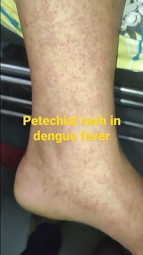 dengue fever (petechial rash)