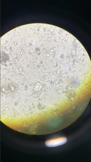 Budding Yeast Cells and High Pus Cells in Urine UNDER MICROSCOPE