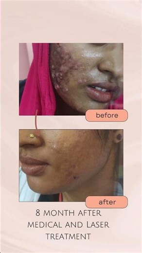 Acne Scar Before & After – 8 Months of Treatment Transformation