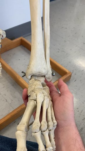 BROKEN ANKLE!! Personally I think ankle nubs is a better name than malleolus.. #ankle #futuredoctor #foot #scienceclass #scienceiscool #anatomy #bio