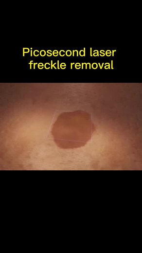 #Picosecond #laser #freckle #foryou #fypage