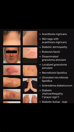 Type 2 diabetes commonly presents with various skin manifestations, affecting up to 30% of patients and sometimes appearing as the first sign of the condition. These range from strongly associated lesions like diabetic dermopathy to infections exacerbated by poor glycemic control. Strongly Associated Manifestations • Diabetic dermopathy (shin spots): Brown or reddish-brown spots on shins, often scaly initially, causing small dents. • Acanthosis nigricans: Velvety, dark patches in skin folds like