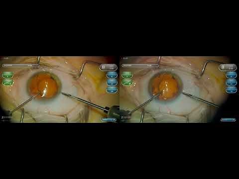 3D Surgery: IOL Exchange