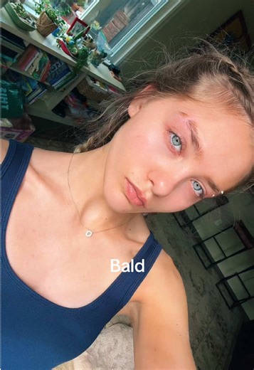 Eyebrow Reshaping for Bald Individuals