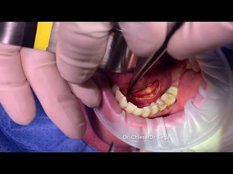 Transoral Sialolithectomy - Left Wharton´s duct