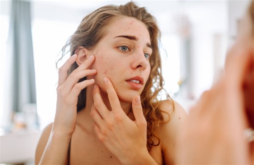 Vous avez une poussée de boutons inattendue ? Votre barrière cutanée est peut-être abîmée - Elle