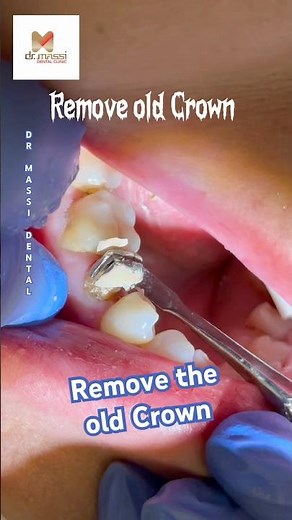 “Removing an old crown” procedure #dentist #viral