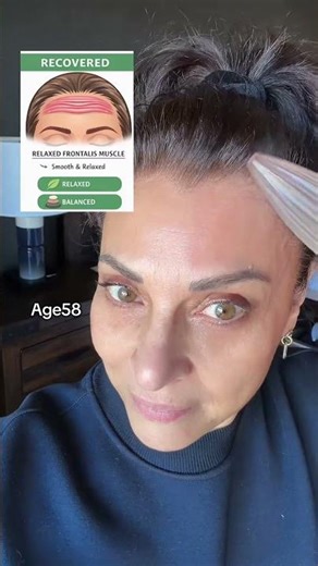 The forehead muscle (frontalis) lifts the eyebrows