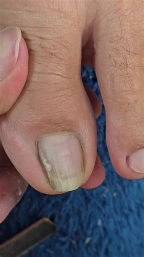 Manicure Tips: Ingrown Toenails Removal Process