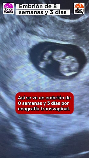 Así se ve un embrión de ocho semanas por ecografía transvaginal.1. "Embarazo semana 8"2. "Desarrollo del feto en la semana 8"3. "Síntomas del embarazo a las 8 semanas"4. "Consejos para mamás de 8 semanas de embarazo"5. "Alimentación durante el embarazo de 8 semanas"6. "Ejercicios seguros para embarazadas de 8 semanas"7. "Cuidados prenatales en la semana 8 de embarazo"8. "Ultrasonido a las 8 semanas de embarazo"9. "Cambios hormonales en el embarazo de 8 semanas"10. "Experiencias de mujeres embara