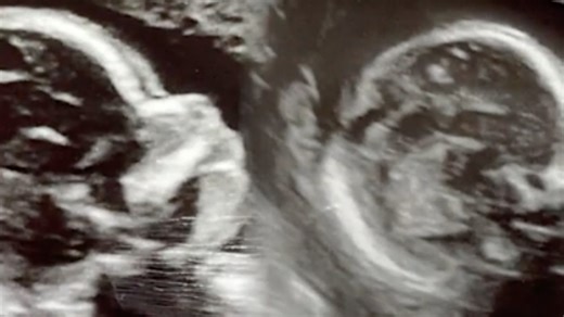 2 babies, 2 separate pregnancies: Alabama woman born with double uterus pregnant in both