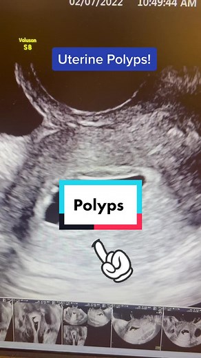 Understanding Polyps and Uterine Polyps