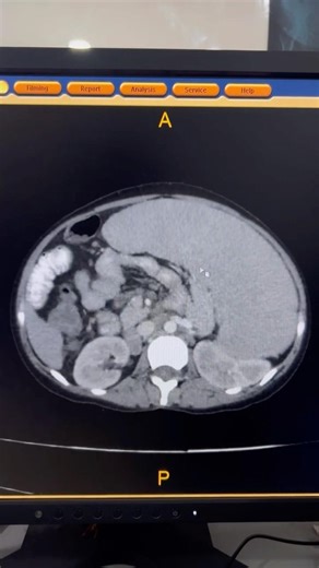Gross Splenomegaly in Teen | CT Scan CLD #shorts