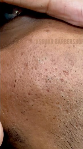 Sac be spa blackhead removal asmr facial scrub #400 #4k #scrub #facialspots #facial #profacial