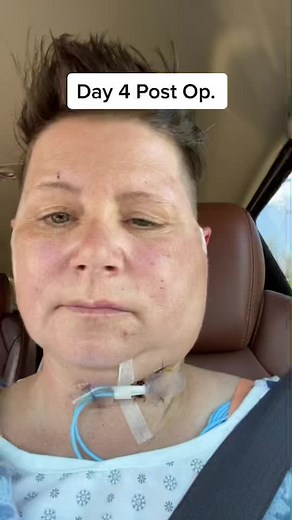 Day 4 Post Op - Parotidectomy Recovery Journey