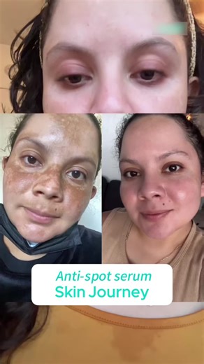 Say Goodbye to Dark Spots with One Product