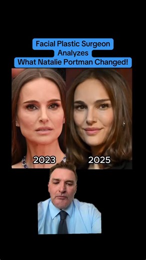 People keep asking, “What changed?” — and this is a perfect example of what excellent facial rejuvenation actually looks like. Notice what you don’t see: No overfilled cheeks. No tight or pulled skin. No frozen expression. Instead, you see balance, structure, and softness. This kind of result is most consistent with a comprehensive facial rejuvenation approach—one that focuses on repositioning and restoration, not chasing trends or adding excess volume. The face looks lifted without looking surg