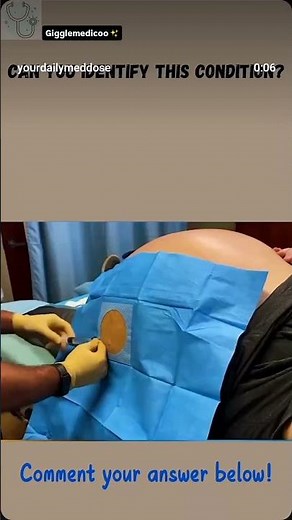 A patient wd abdominal distension fluid wave ,shifting dullness undergoes this procedure #diagnosis