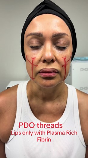 PDO thread lift is a non-surgical cosmetic procedure that uses dissolvable sutures (threads) to lift and tighten sagging skin, primarily in the face. These threads are inserted into the skin, creating an immediate lifting effect and stimulating collagen production for long-term results. PRF, or Platelet-Rich Fibrin, lip injections are a natural alternative to traditional lip fillers that aim to enhance lip volume, smooth wrinkles, and improve lip texture.#PDO#pdo #houstonpdo #prf #prflips