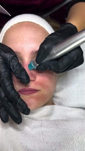 HydraFacial Treatment | Deep Cleansing, Hydration & Glowing Skin