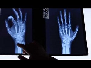 Fractura del quinto metacarpiano.