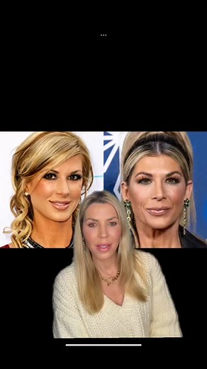 Alexis Bellino—Real Housewife, real transformations! Let’s take a closer look at her before and after and break down the subtle (and not-so-subtle) changes that may have enhanced her look. What do you think? | Jennifer Armstrong, MD