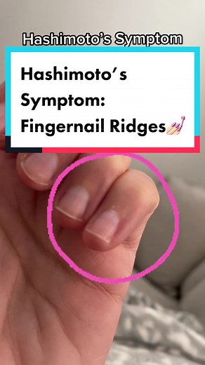 Understanding Hashimoto’s Symptom: Fingernail Ridges