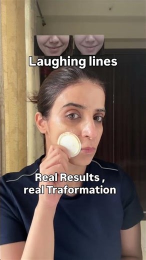 Laughing lines & forehead lines