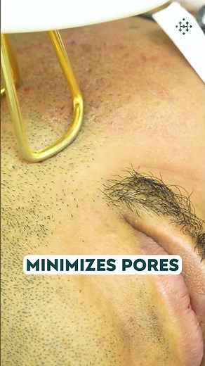 Fractional CO2 Laser Treatment | Acne Scar & Skin Resurfacing