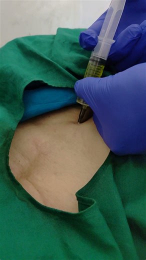 gate prolo inj for severe low back pain