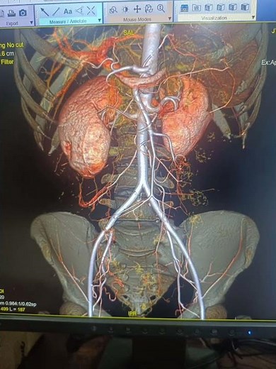 CT Mesenteric Angiography #radiology #ctscan #viral #viralvideo #trending #knowledge #science