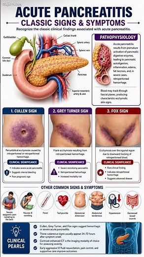 Acute Pancreatitis Explained in 60 Seconds | Medical Anatomy # #anatomy #healthcare #shorts