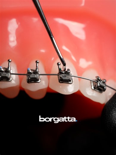 Te mostramos el uso correcto de la dupla para brackets de autoligado, garantizando una apertura y cierre fluido sin dañar el bracket. 🦷✨ Trabaja con la herramienta exacta para cada técnica. 🛒 Consíguela en Tienda Borgatta a través del enlace en nuestra bio.