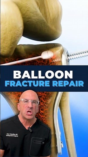 Why This Surgeon Uses a Balloon Inside Your Knee #surgery #doctor #medicalshorts