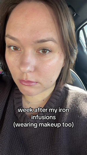 Iron Infusion Results: My Face Before & After for Anemia