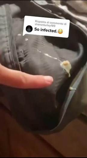 Cystic Acne Removal & Inflammatory Acne