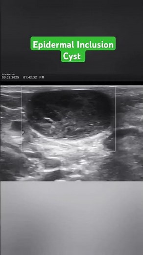 Epidermal Inclusion Cyst in Ultrasound #ultrasound #pocus #medical_imaging
