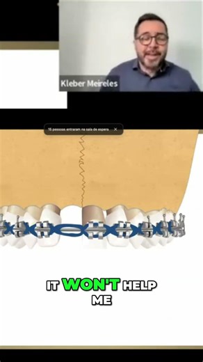 Closing Gaps: Step-by-Step Dental IPR Technique #shorts