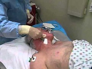 ACLS：経静脈ペーシング【詳しくはこちら：www.proceduresconsult.jp】