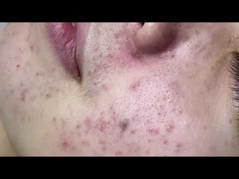 Pimple Popping #pimplepopping & Blackhead Extraction Compilation | Satisfying Acne Removal Close#026
