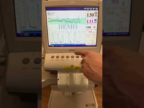 EDAN F9 Express CTG Monitor Training Video