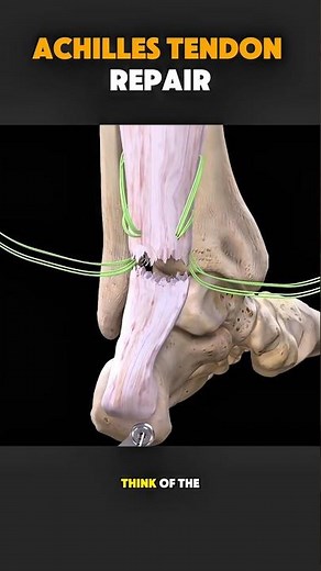 How Achilles Tendon Repair Surgery Is Done (3D Animation) | Step‑by‑Step