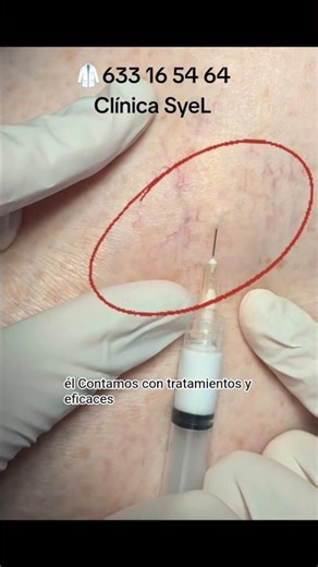 💉😱 Las técnicas de la que todos están hablando. arañas vasculares en clínica SyeL