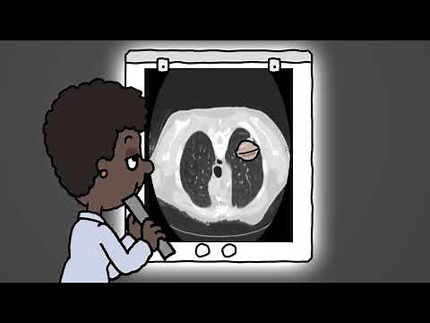 Response Evaluation Criteria in Solid Tumors (RECIST)