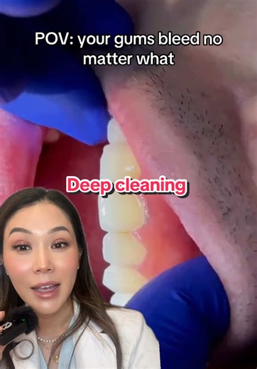 PSA: Dental Hygienist Reveals Truth About Tartar Removal