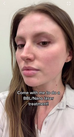 Here’s a day by day breakdown of my BBL Nano laser treatment I had done a last fall! Here’s what it does: BBL addresses pigmentation (brown and red), broken blood vessels, and overall collagen stimulation which can smooth and tighten skin. The nano laser is a very superficial laser to help with superficial resurfacing and some of those stubborn light brown spots. It’s in the same family as the HALO laser, but it doesn’t go as deep so it doesn’t come with the same downtime. Treatment courtesy of 