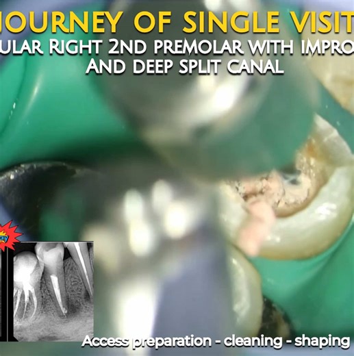 Single Visit Endodontics: Mastering Tricky Tooth Anatomy