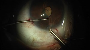 Explanting an Anterior Chamber Phakic IOL - Eyetube